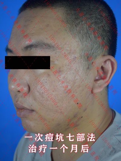 痘坑后.jpg
