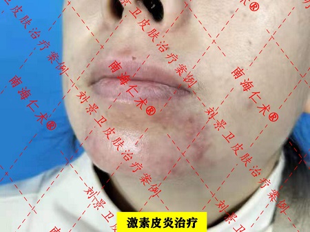 激素皮炎.jpg