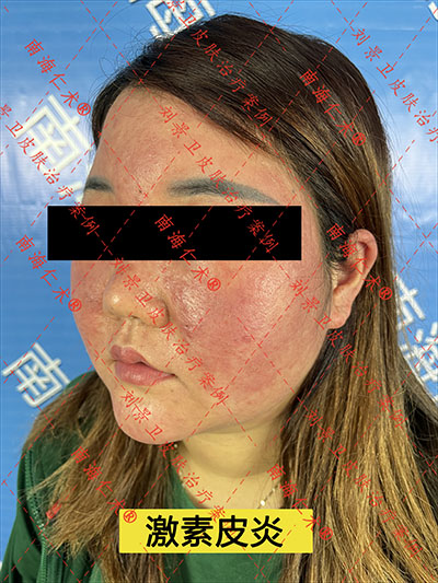 激素皮炎000.jpg