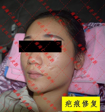 疤痕.jpg