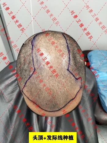 头顶发际线植发.jpg