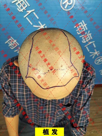 植发划线.jpg