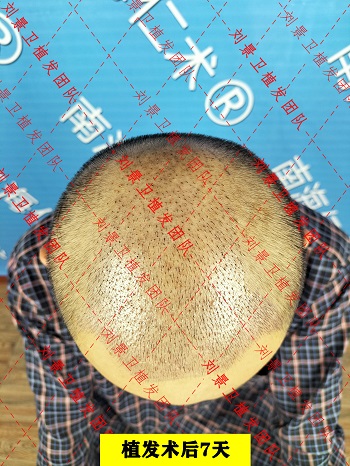 植发术后7天.jpg