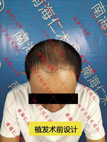 头顶发际线植发1.jpg