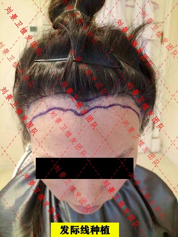 发际线植发.jpg