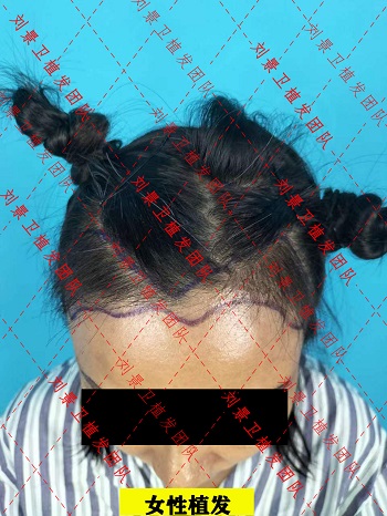 女性发际线.jpg