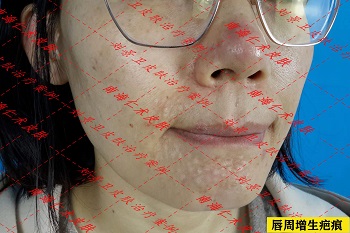 唇周增生疤痕.jpg