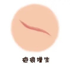 疤痕增生.webp.jpg