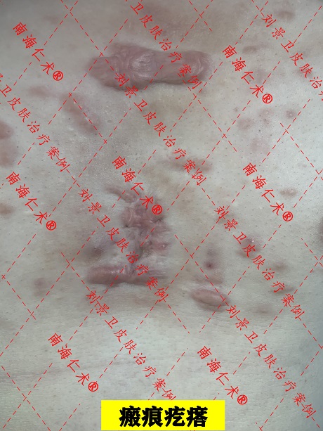 瘢痕疙瘩.jpg