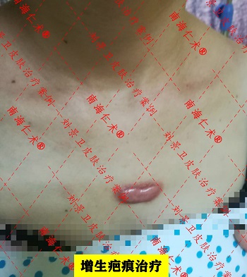 增生疤痕1.1.jpg