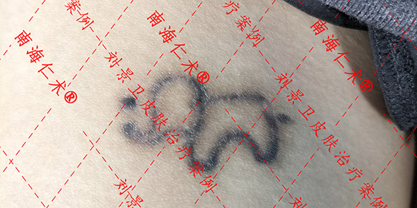 海南省皮肤医院洗纹身.jpg