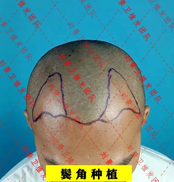 鬓角种植发.jpg