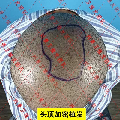 头顶加密植发术.jpg