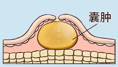 皮脂腺囊肿1.1.webp.jpg