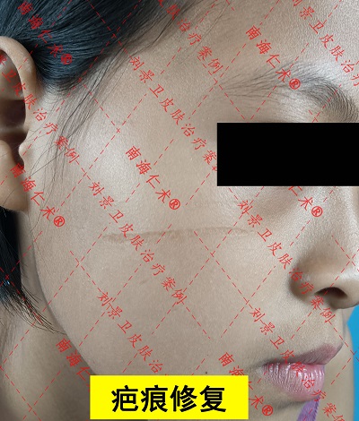 面部疤痕修复.jpg