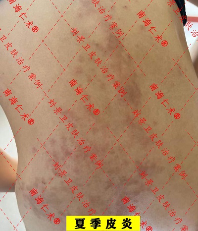 夏季皮炎.jpg