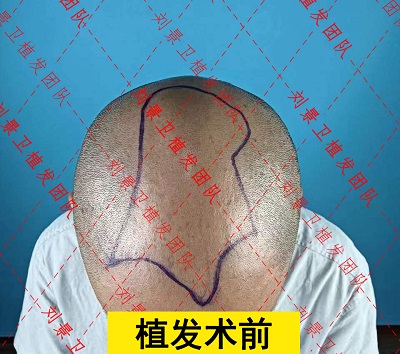 头顶加密术前.jpg