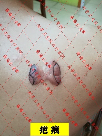 疤痕切除.jpg