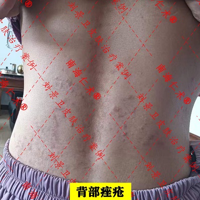 背部痤疮.jpg