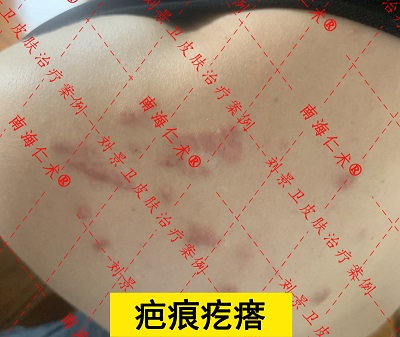 肩膀疤痕疙瘩.jpg