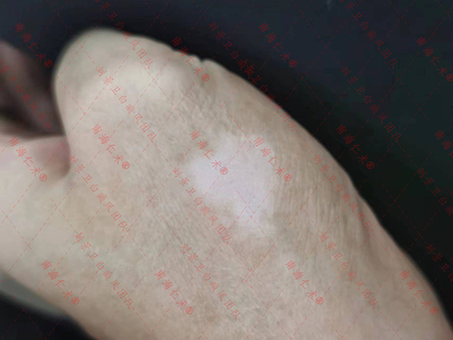 海口仁术白癜风.jpg