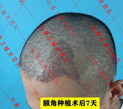 额角种植术后7天1.1.jpg