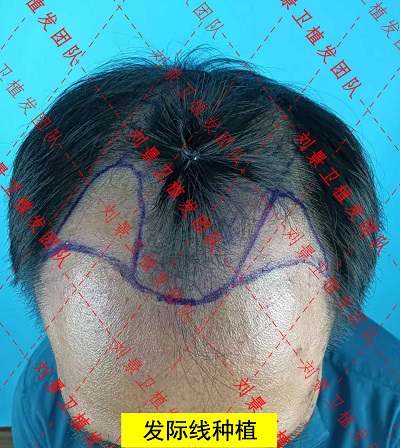 发际线男性种植.jpg