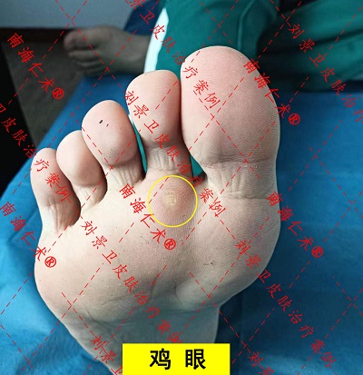 鸡眼脚上.jpg