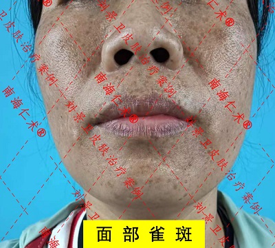 面部雀斑1.jpg