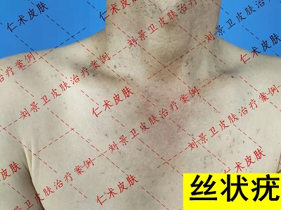 丝状疣1.jpg