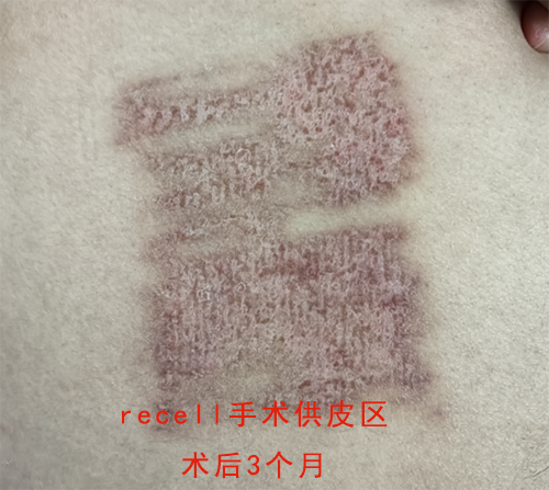 术后2个多月.png