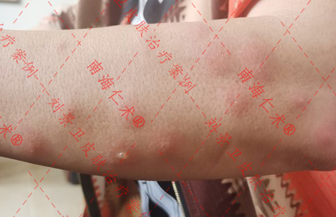 痒疹 (2).jpg