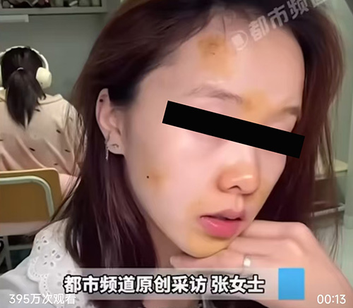 痤疮痘痘.jpg